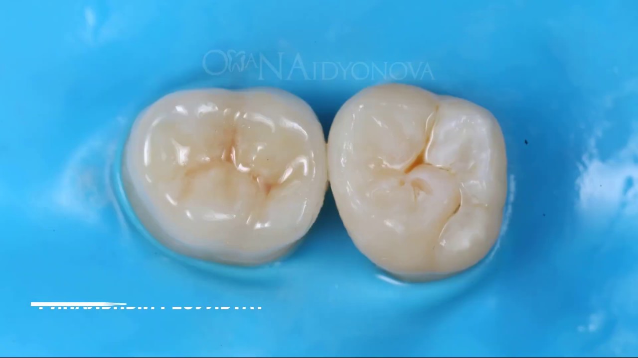 Fixation VITA Enamic  on a heated composite. Фиксация overlay VITA Enamic на разогретый композит.