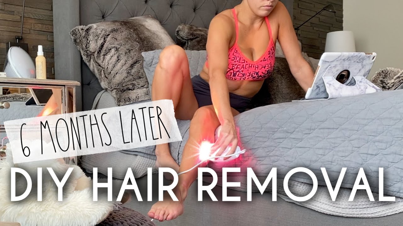 IPL Hair Removal at home | 6 Months Later