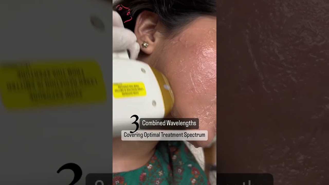 Soprano ICE Platinum Laser Hair Removal