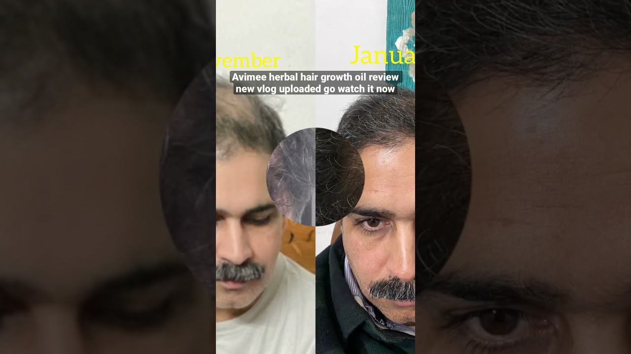 Avimee herbal hair growth oil #review #hairgrowth #baldness #hairfall #hairgrowthtips #hairoil
