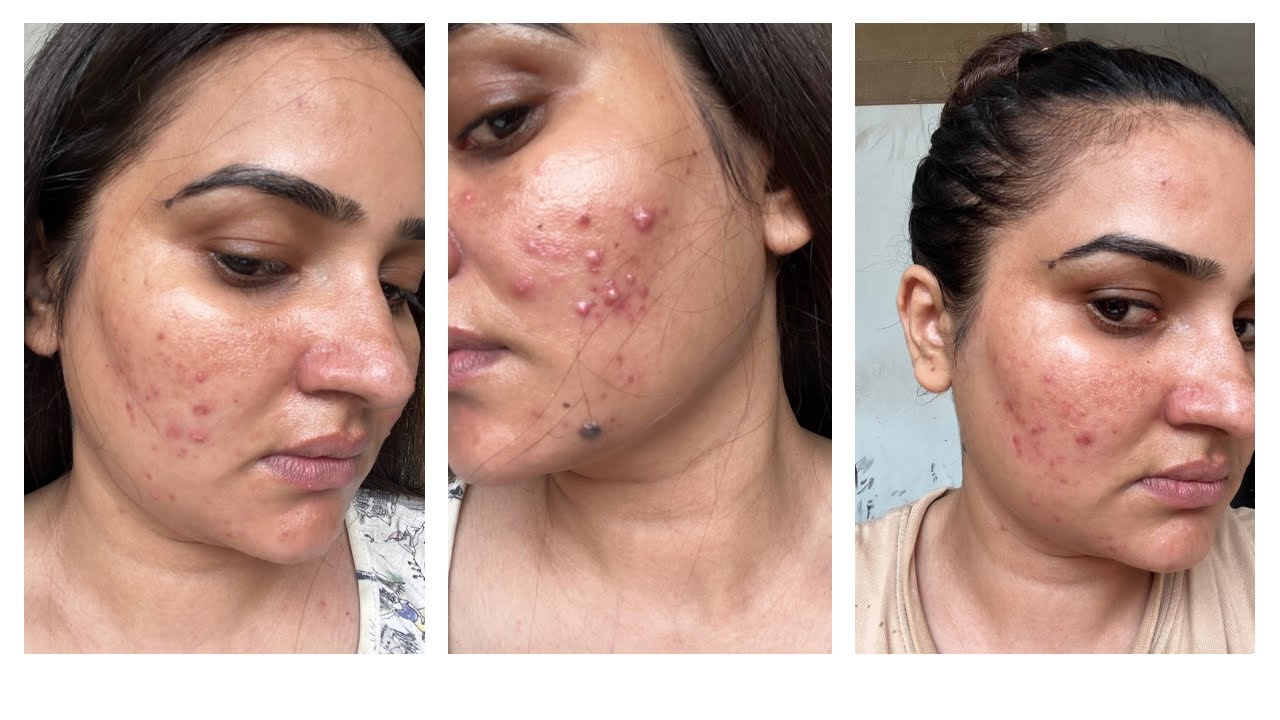 I’m Adding Alpha Arbutin to My Skincare Routine | For Pigmentation, Dark Spots & Glow |Skincare