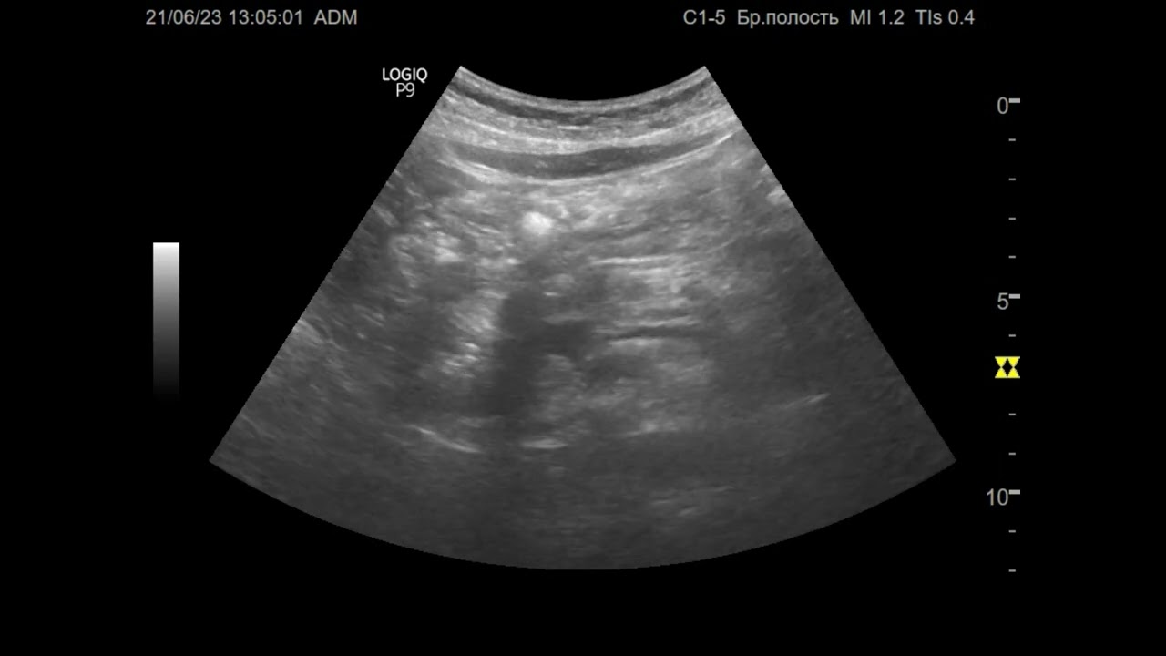 УЗИ. Доктор Иогансен. Видеопримеры. Выпуск 22. Дилатация панкреатического протока.