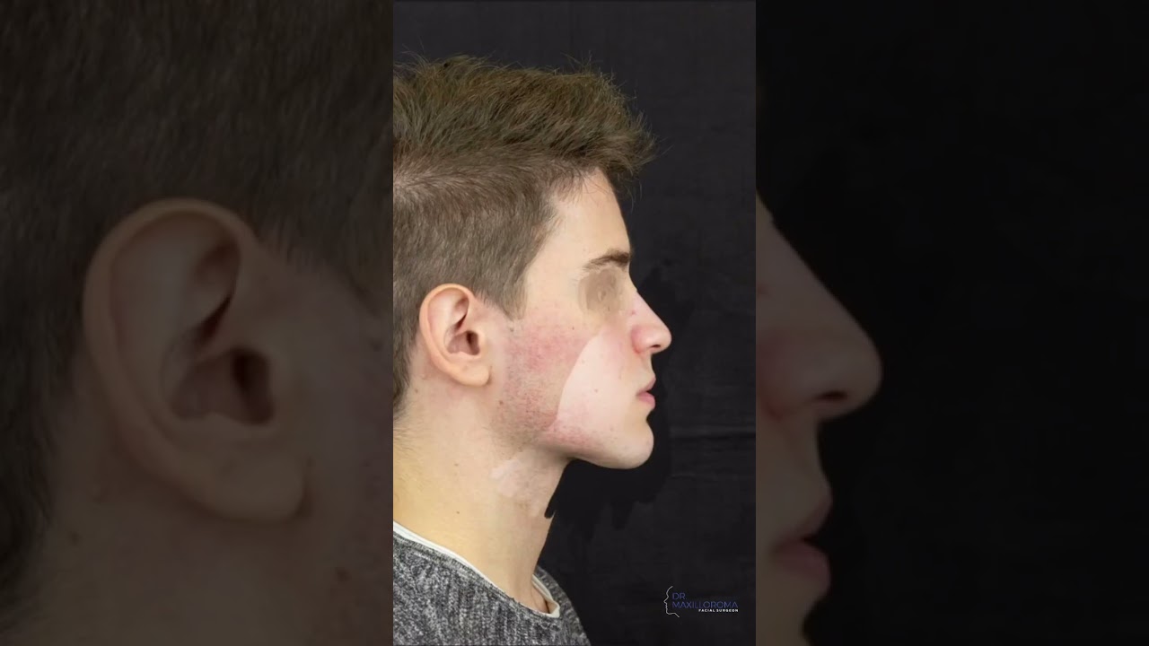 In questo breve video vi mostro una correzione chirurgica mascellare, mandibola, mento con rotazione