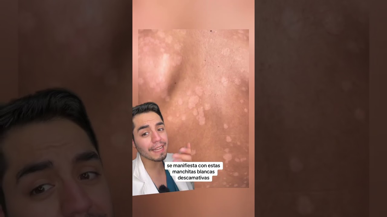 Esto no es #vitiligo es #pitiriasis #versicolor #pitiriasisversicolor #hongo