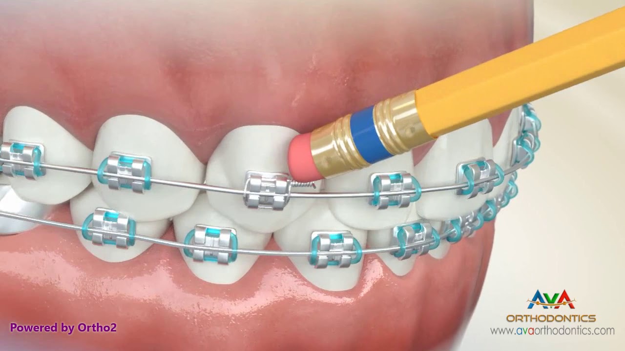 How to Manage Orthodontic Emergencies - Pokey Wire & Pencil Eraser