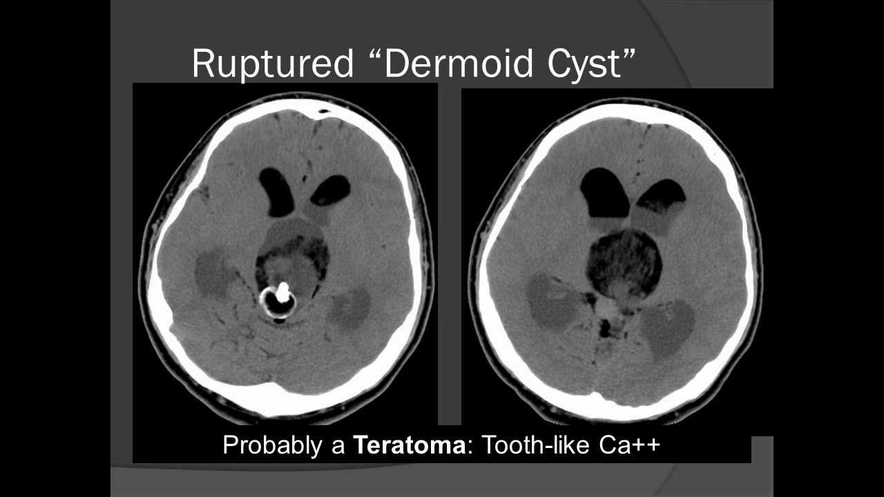 Pineal Region Tumors: Radiologic-Pathologic Correlation