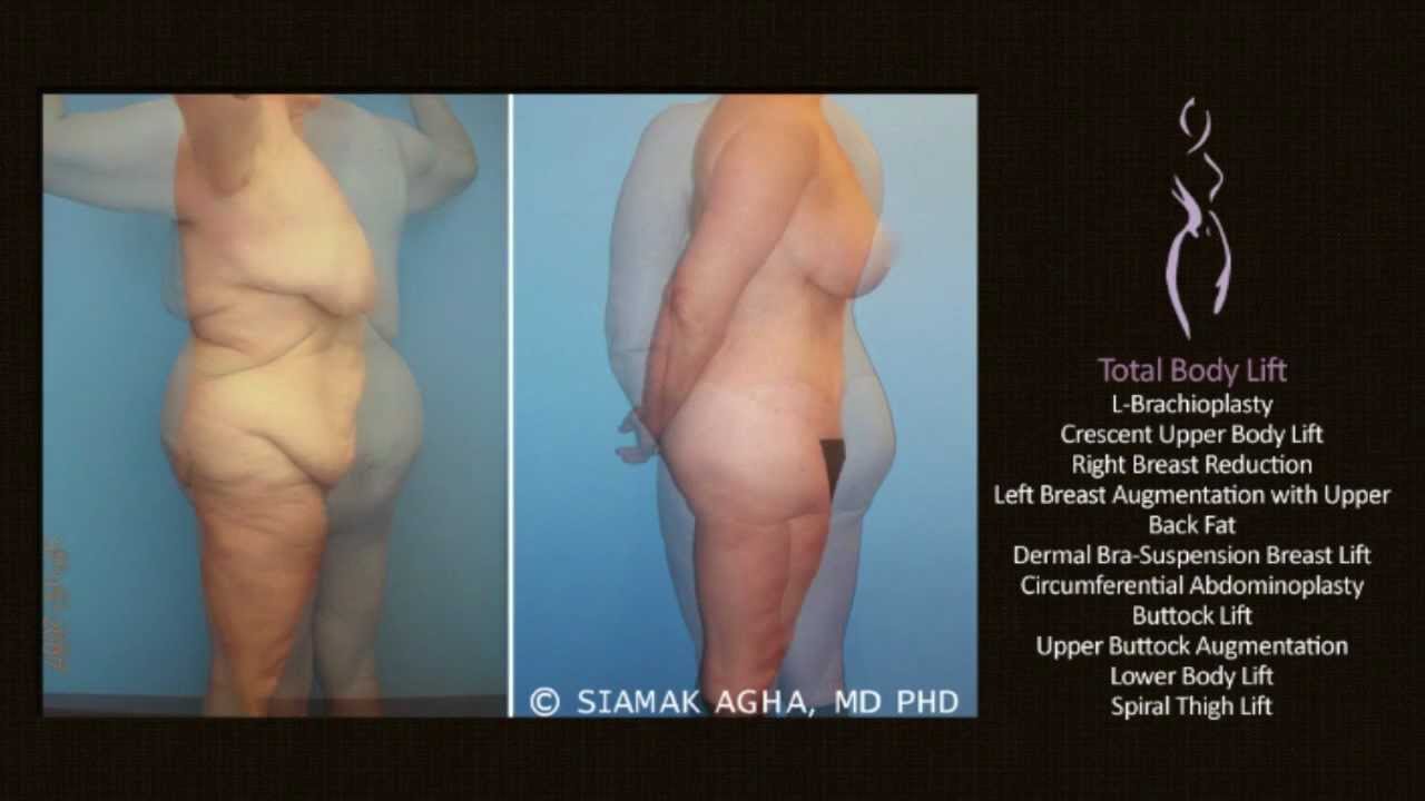 Complete Body Lift