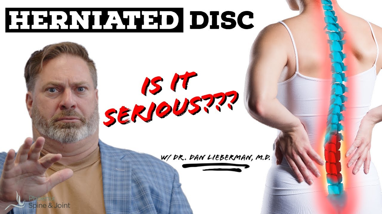 Is A Herniated Disc Serious? | When You NEED To Take Action