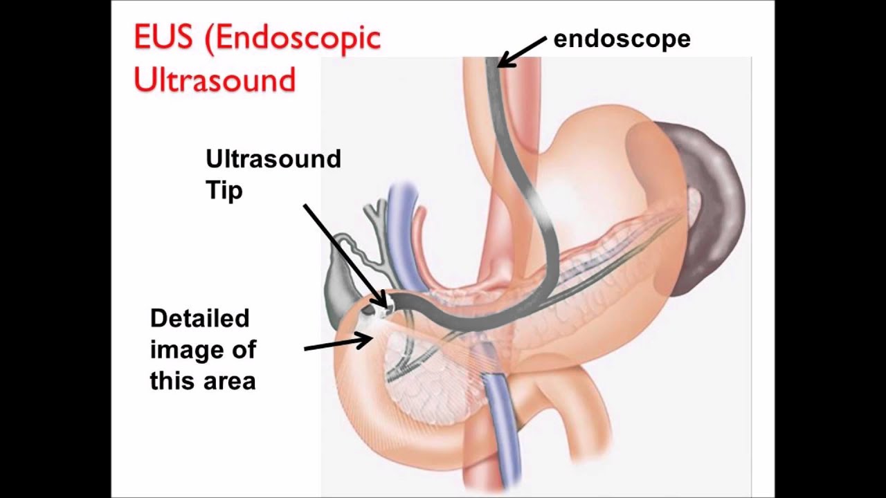 Pancreas Cancer