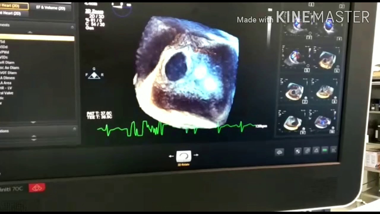How to use 3D Zoom to diagnose an Atrial Septal Defect (ASD)