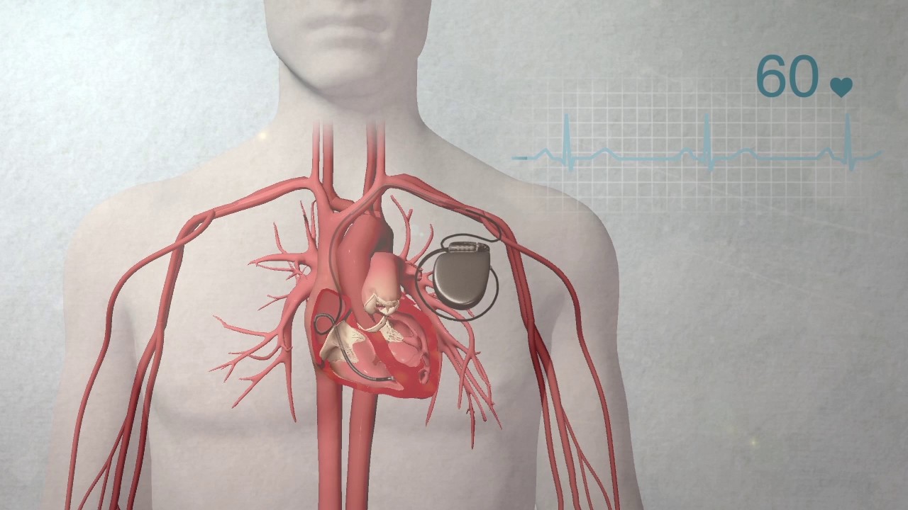 What is a pacemaker