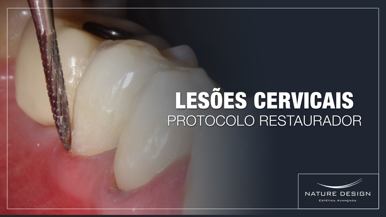 LESÕES CERVICAIS: PASSO A PASSO DE PROTOCOLO RESTAURADOR
