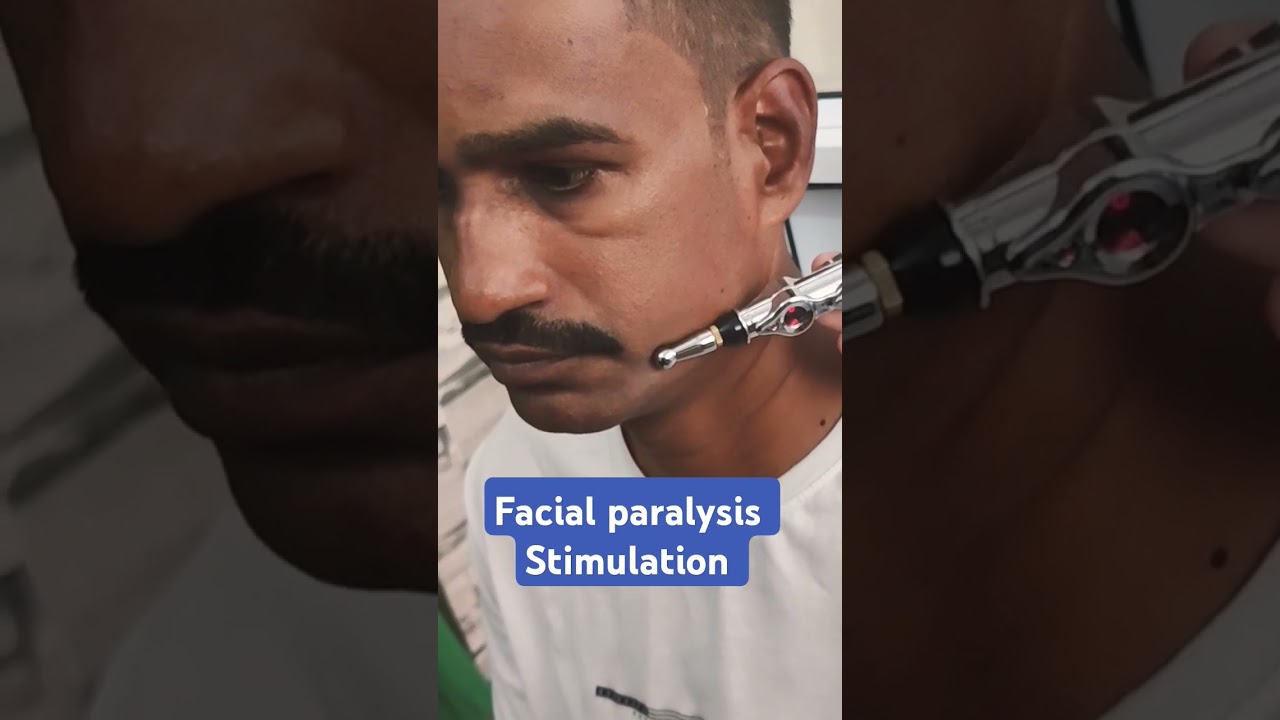 Bell's Palsy treatment #stimulation #pens #paralysis #physiotherapy #drsrk #mumbra #trendingshorts
