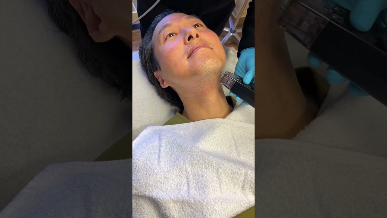 Watch Me Undergo A Morpheus8 Treatment! 