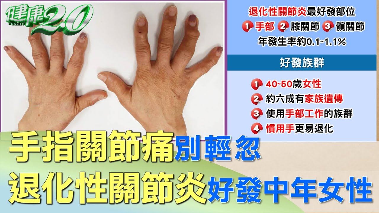 手指關節痛別輕忽 退化性關節炎好發40~50歲女性 健康2.0