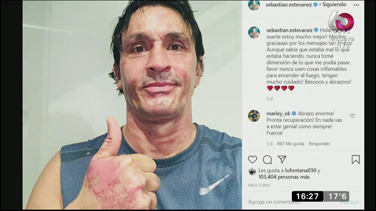Sebastián Estevanez se recupera del terrible accidente doméstico que sufrió
