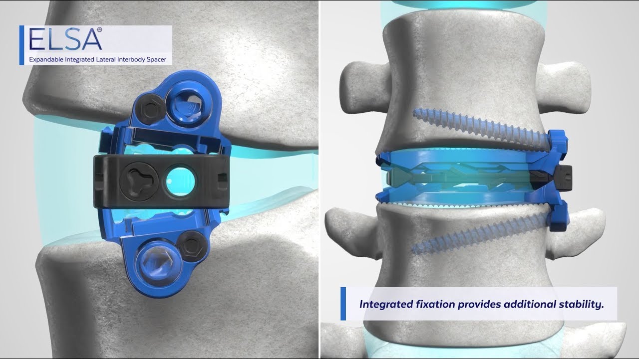 ELSA™ Spacer