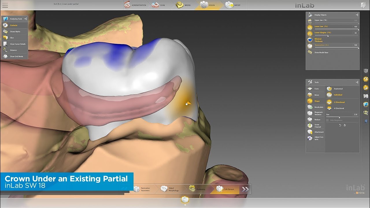 inLab SW 18: How To Do a Crown Under an Existing Partial