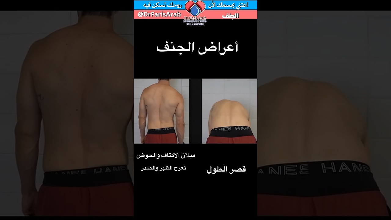 أعراض الجنف
