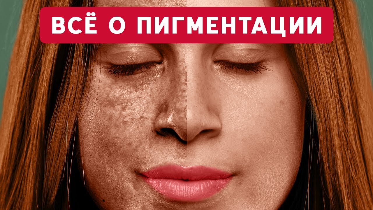 Как УСТРАНИТЬ появление ПИГМЕНТНЫХ ПЯТЕН на коже? / Интервью с ЭНДОКРИНОЛОГОМ