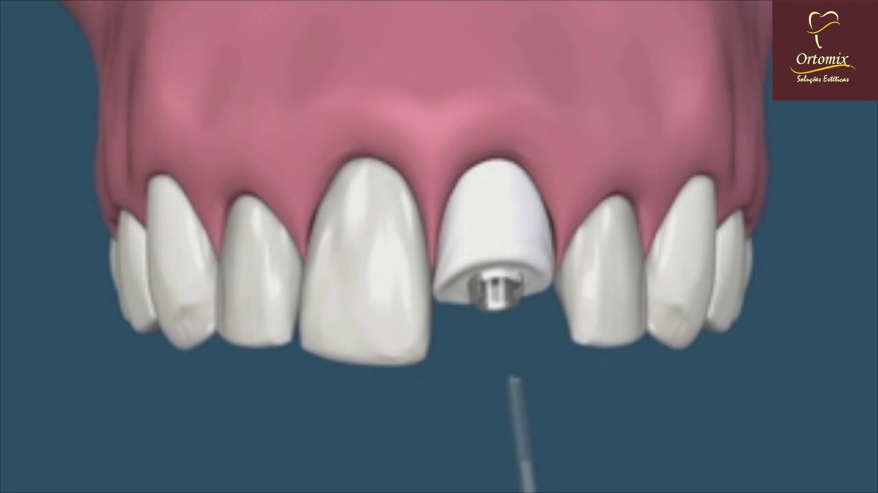 IMPLANTE CARGA IMEDIATA ORTOMIX ODONTOLOGIA BRASILIA