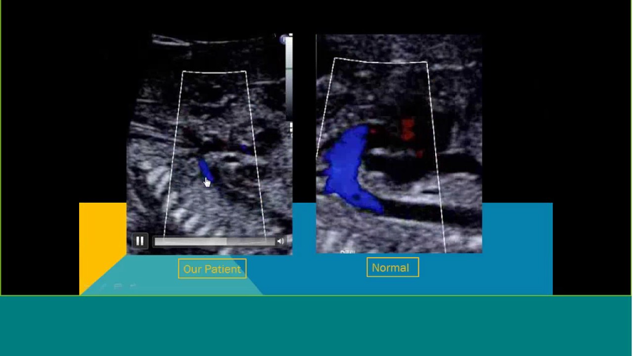Topics in Fetal Medicine: Left-sided Obstructive Lesions in the Fetal Heart