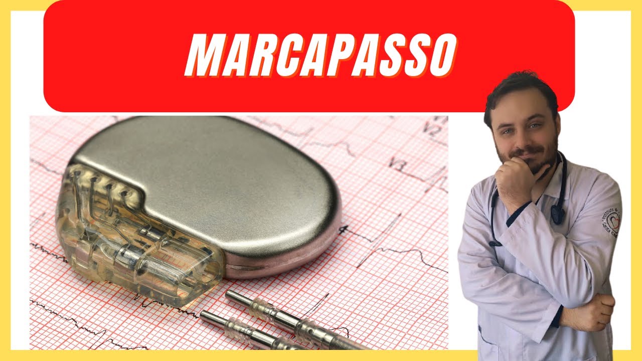 O QUE É MARCAPASSO CARDÍACO? COMO É A CIRURGIA? (TUDO QUE PRECISA SABER)