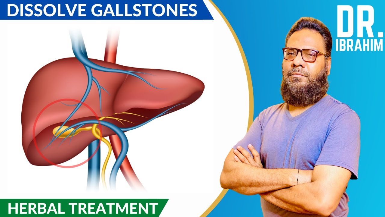 Pity Ki Pathri Ka Ilaj Ayurveda Se (Gallstones) in Urdu/Hindi |  Dr. Ibrahim