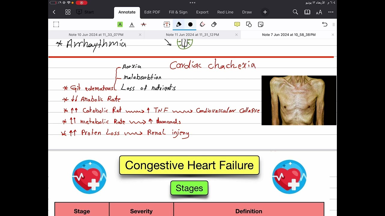 Cardiology // Heart fauilar part 2