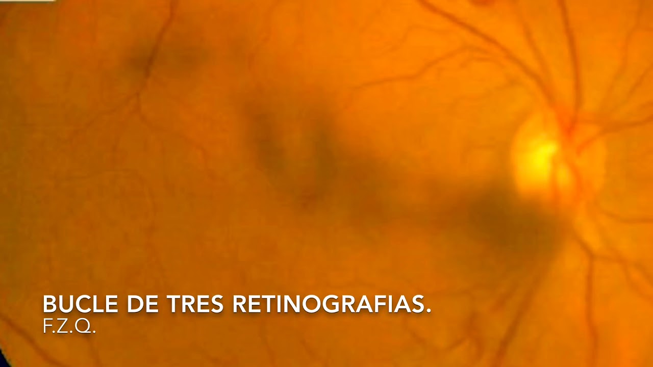 Miodesopsia por desprendimiento de v&iacute;treo vista con retinograf&iacute;as.