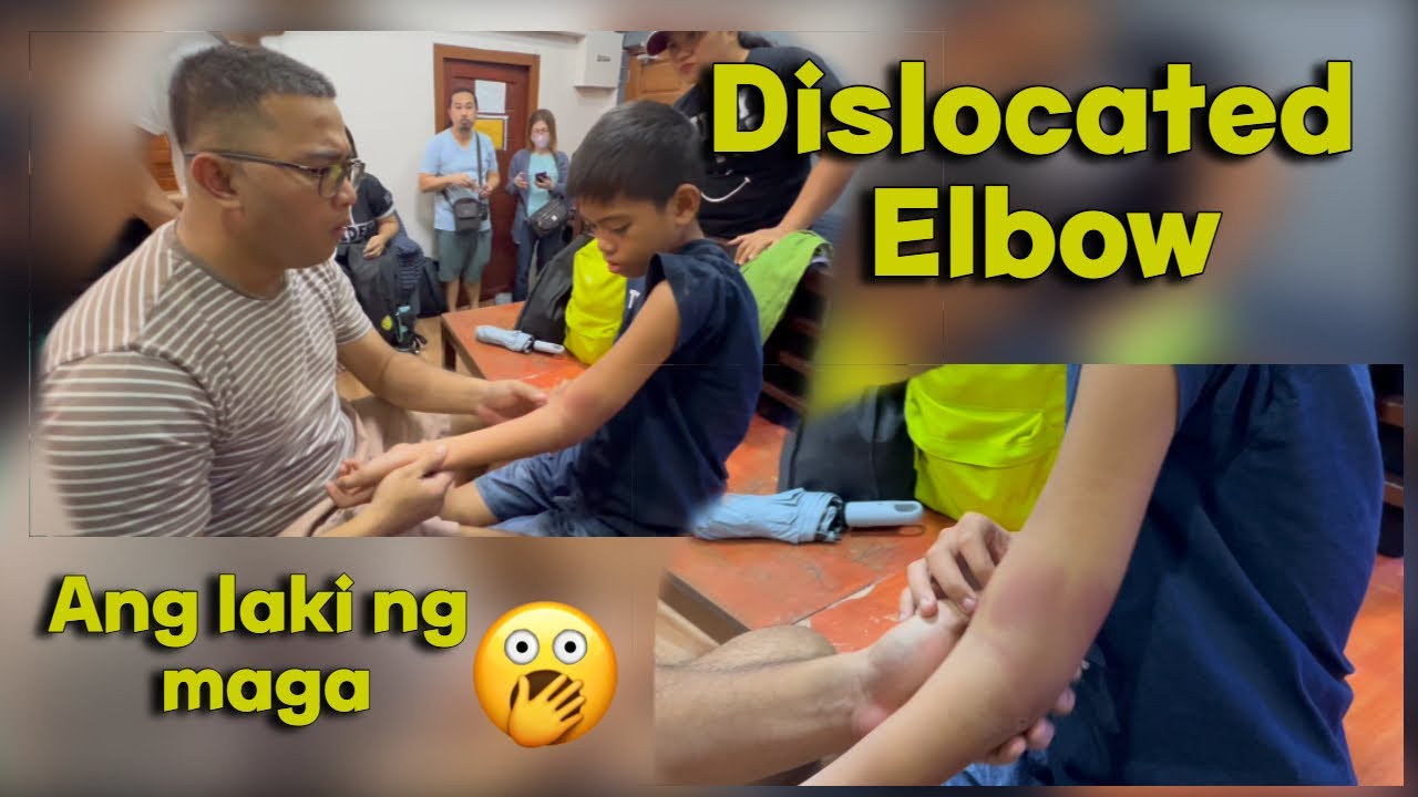 Natukod ang kamay , Sobrang maga nang pagkaka dislocate.
