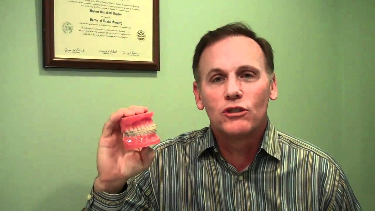 Traditional Braces vs Invisalign