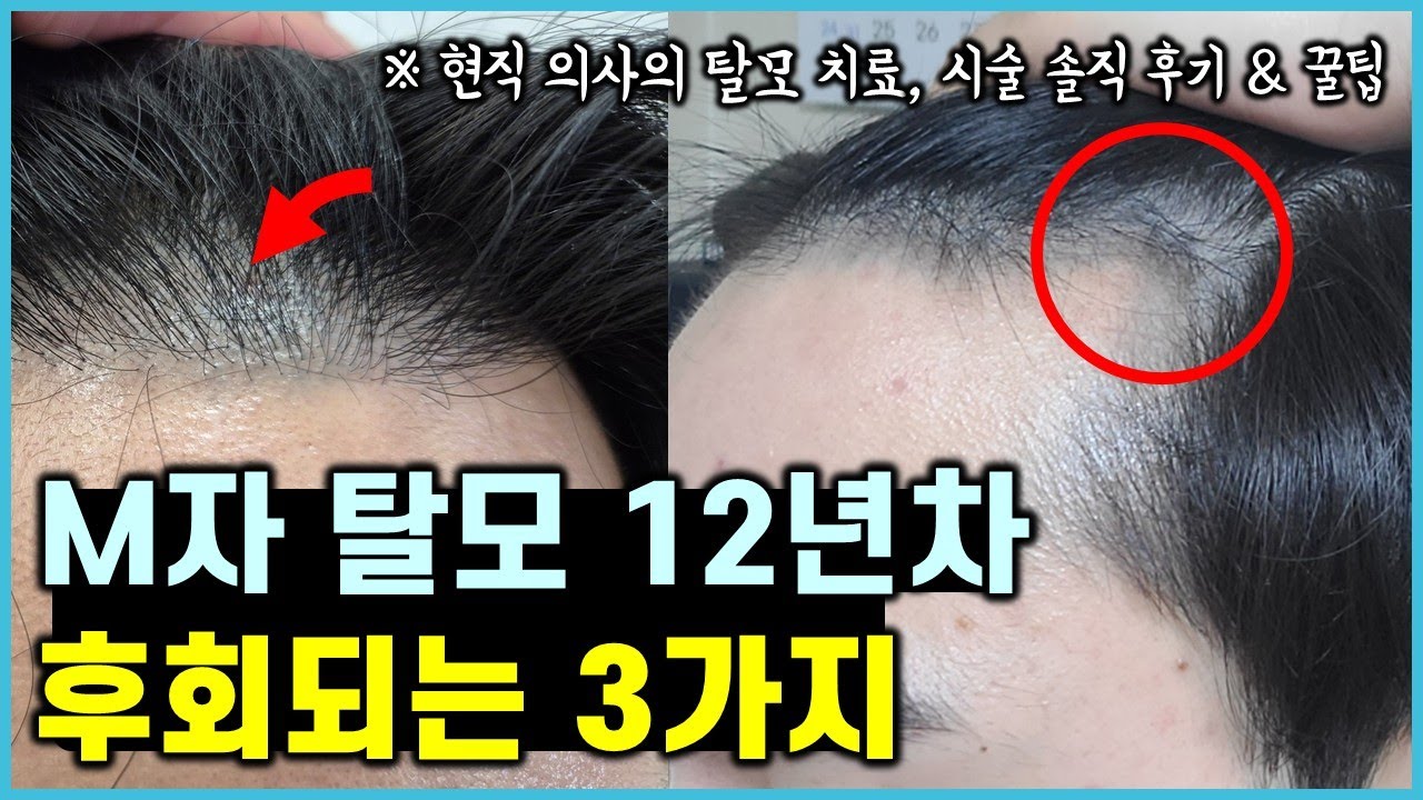 현직 의사의 M자 탈모를 더 심하게 만든 치명적인 3가지 실수 (feat. 탈모약, 모발이식, 두피문신 후기)