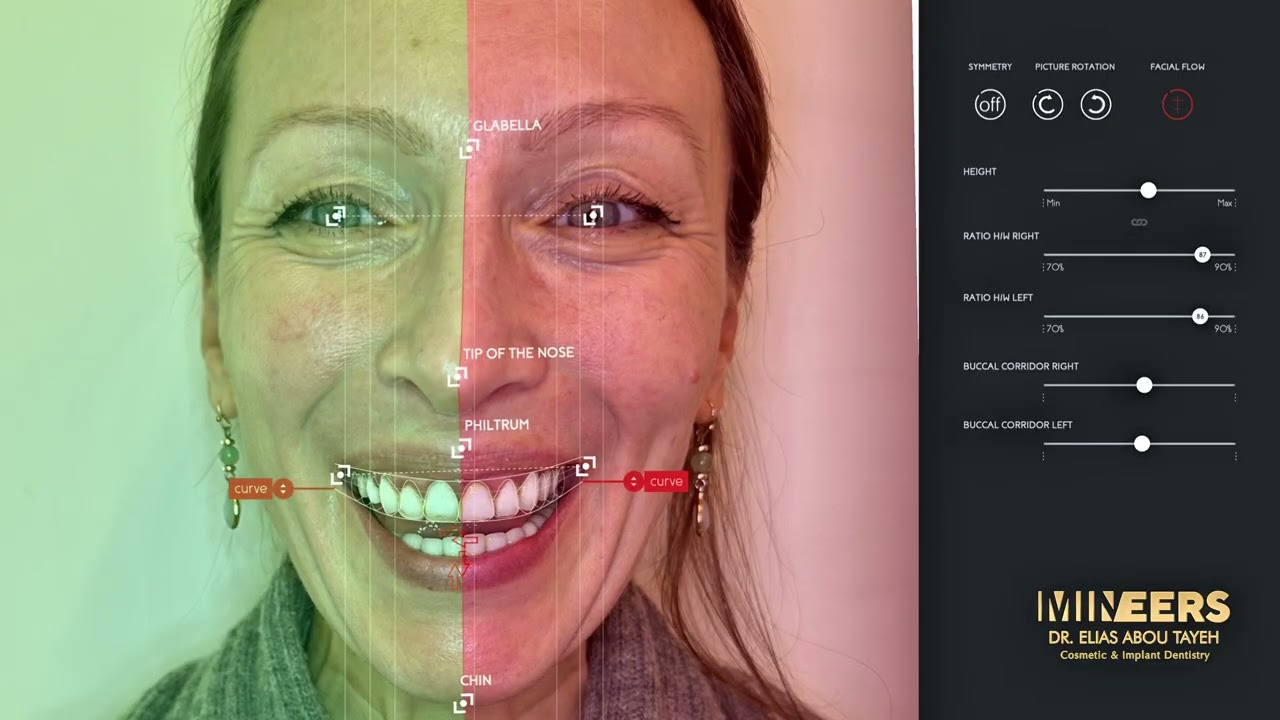 Digital Smile Design at Mineers Smile Center