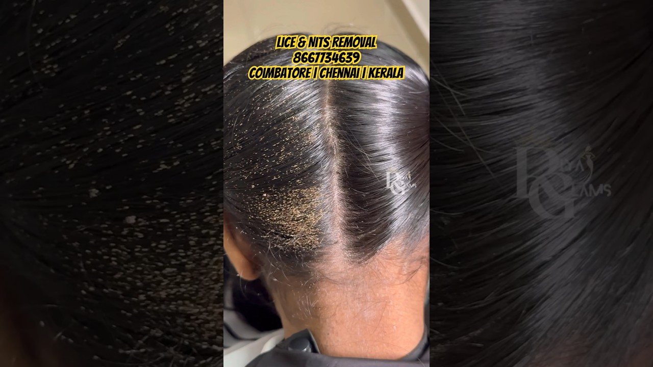 Lice treatment in Chennai/lice treatment in parlour/lice treatment clinic/lice eggs in hair/lice
