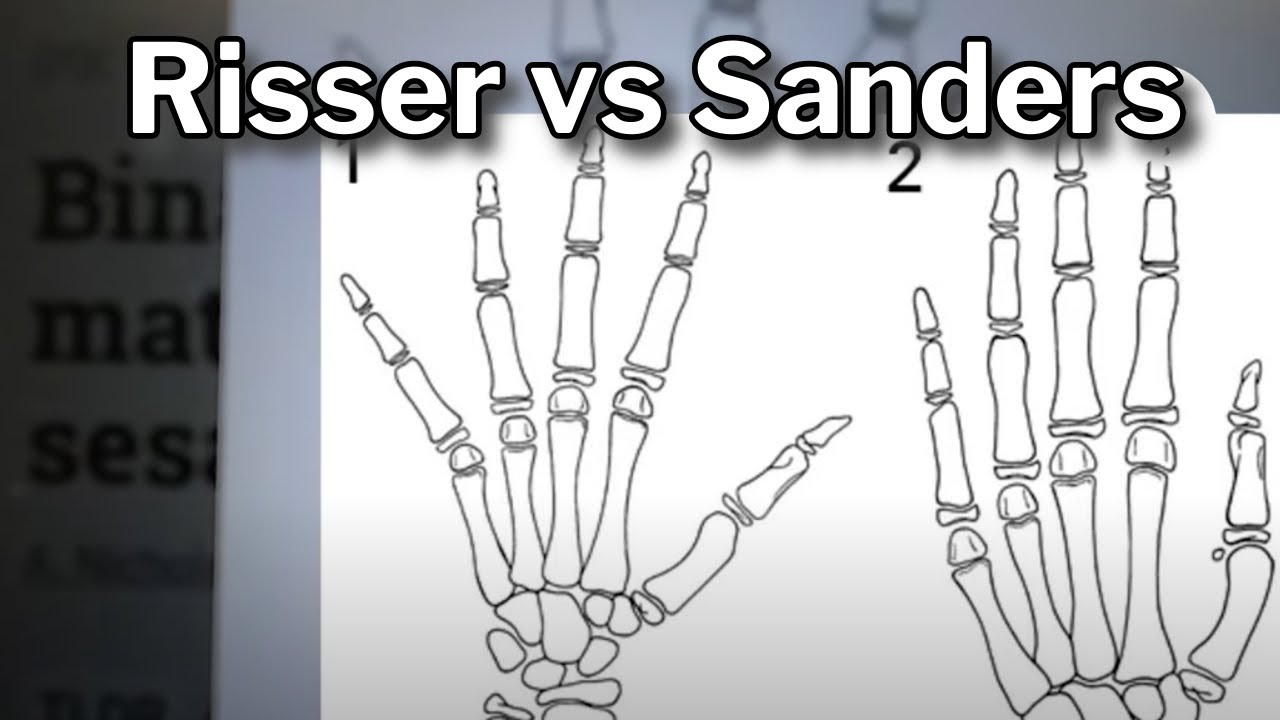 Sanders Scale vs. Risser Score: Determining Growth Potential in Scoliosis Patients
