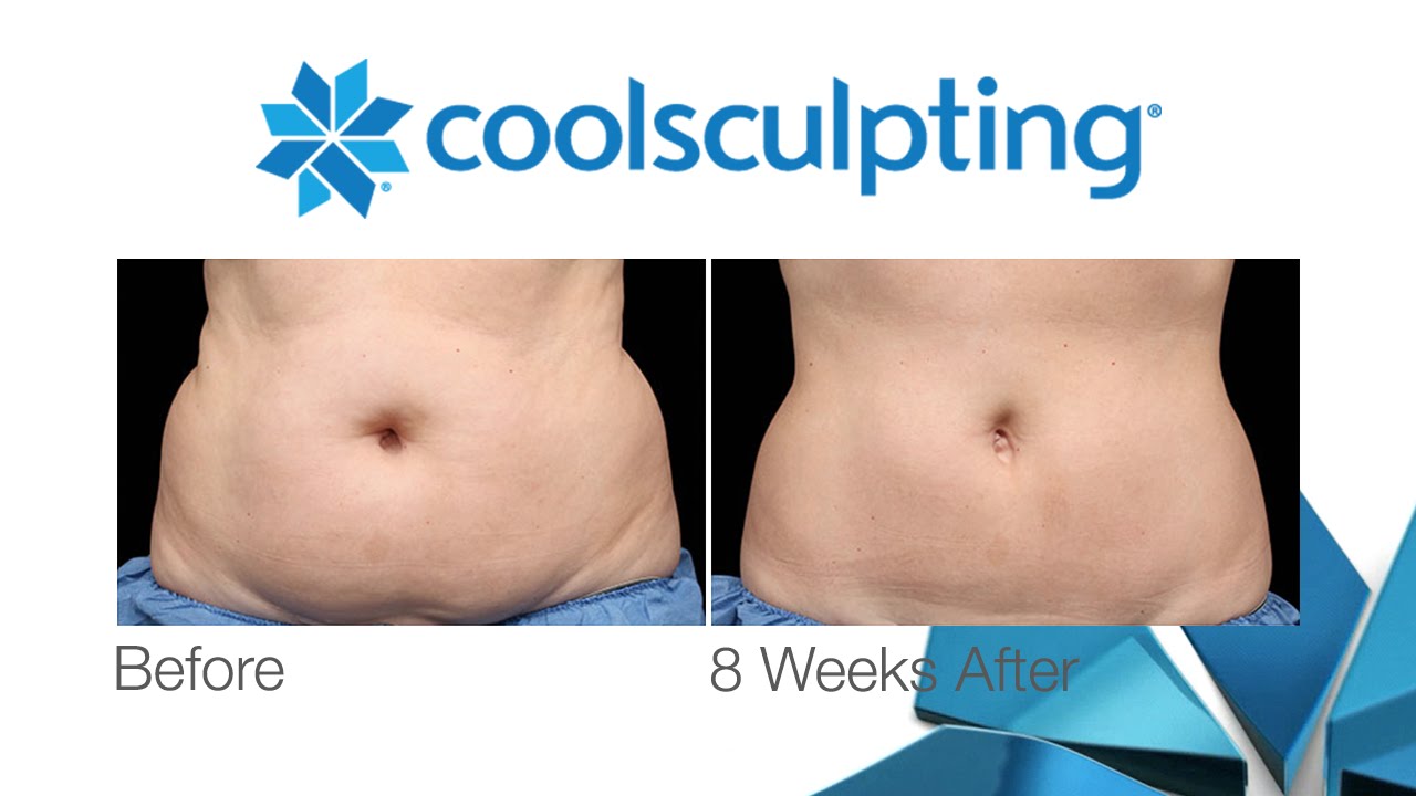 How Does Zeltiq CoolSculpting Work? | The Plastic Surgery Clinic