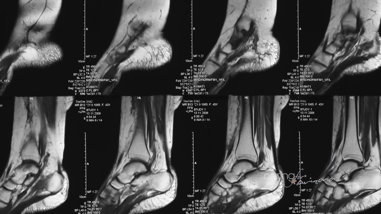 Bone vs Metal