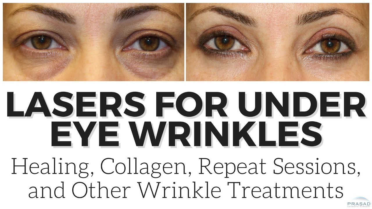 How Collagen Induction Continues after a Laser Procedure, and Other Wrinkle Treatments