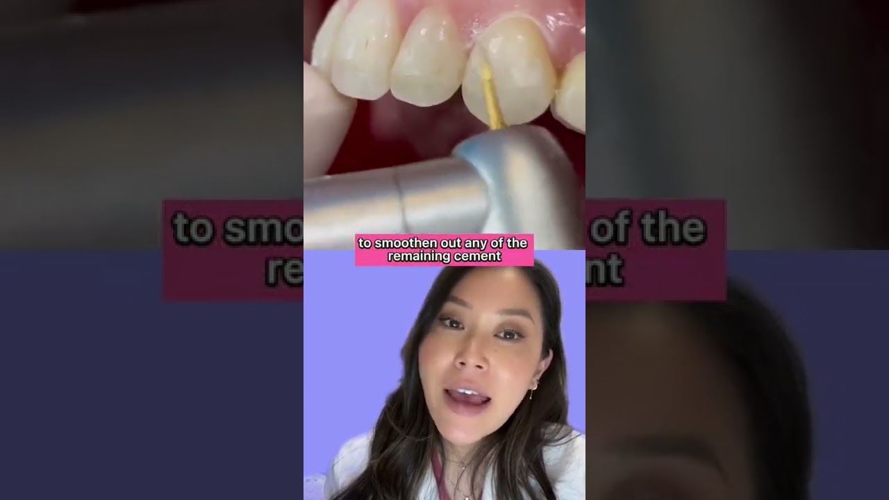 How cement is removed after braces brackets are taken off 