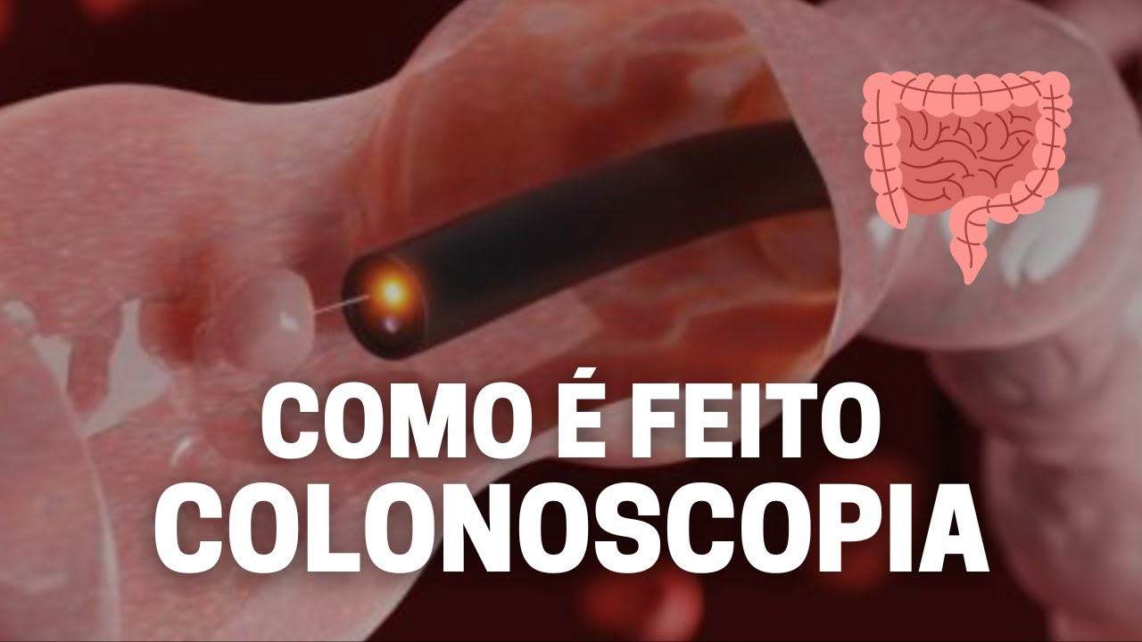 Como é o exame de colonoscopia? [MOSTRANDO TUDO]