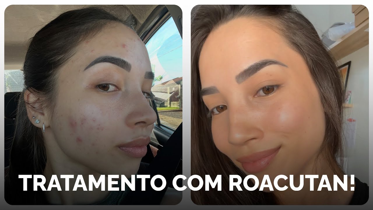Roacutan | tudo sobre meu tratamento: acne, custo, colaterais e resultados