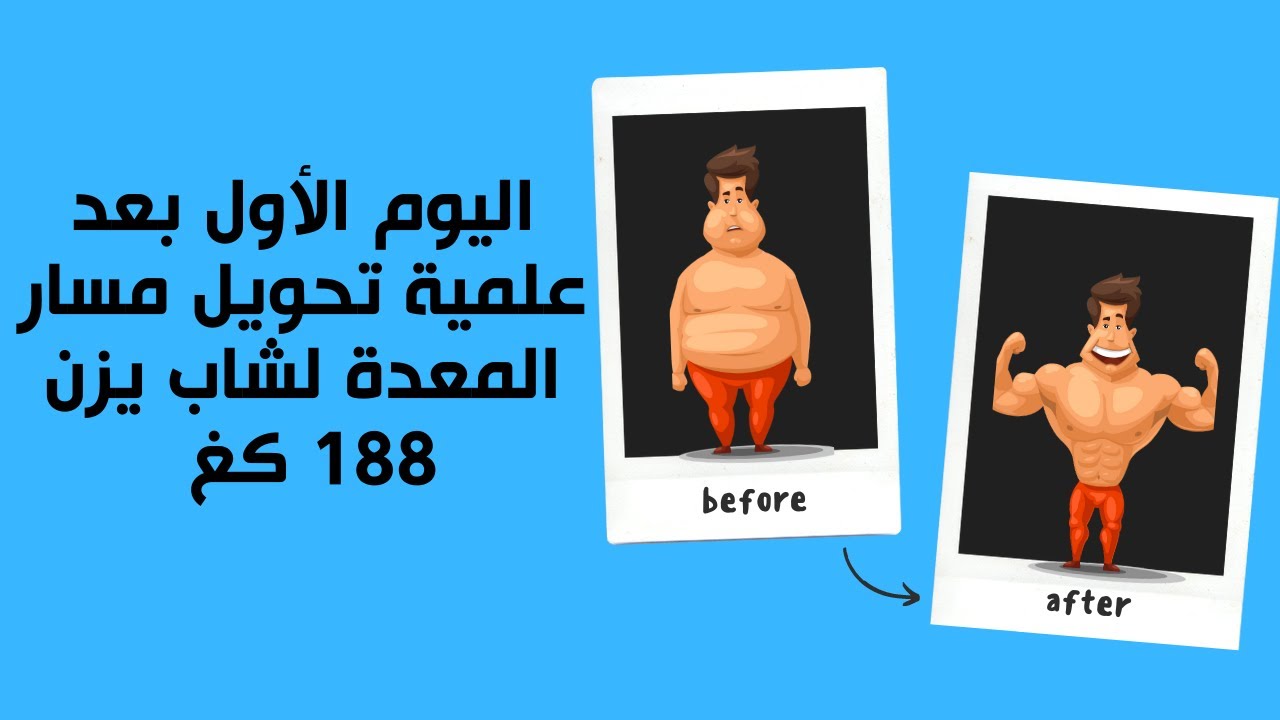 اليوم الأول  بعد علمية تحويل مسار المعدة لشاب  يزن 188 كغ