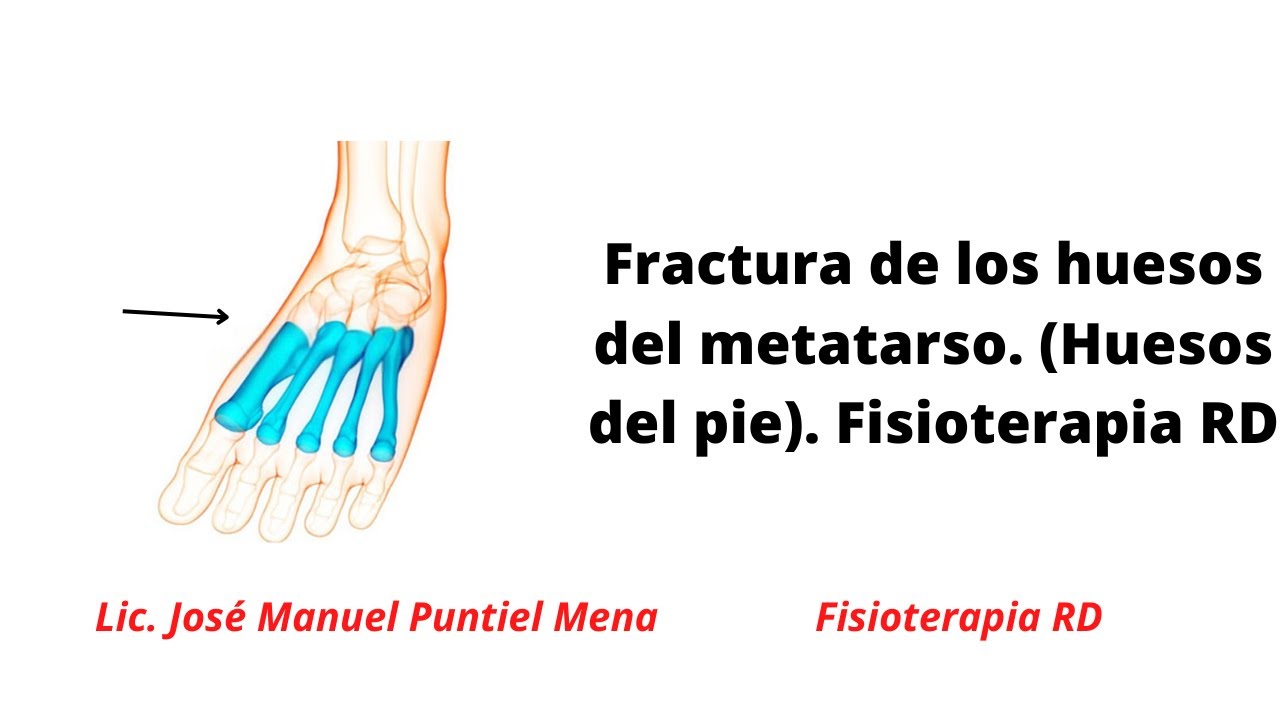 Rehabilitación de fractura pie, automasajes y ejercicios desde el yeso hasta marcha -Fisioterapia RD