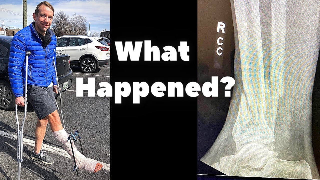 Tib/Fib Fracture (How I broke my leg)