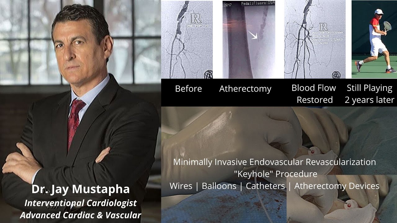 Does Revascularization Increase/Decrease Amputation Risk? | Dr. Jihad Mustapha | PAD | CLI