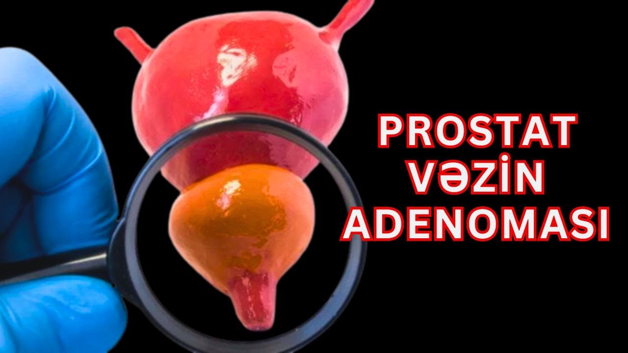 Prostat Vəzin Adenoması Nədir? Simptomları hansılardır?
