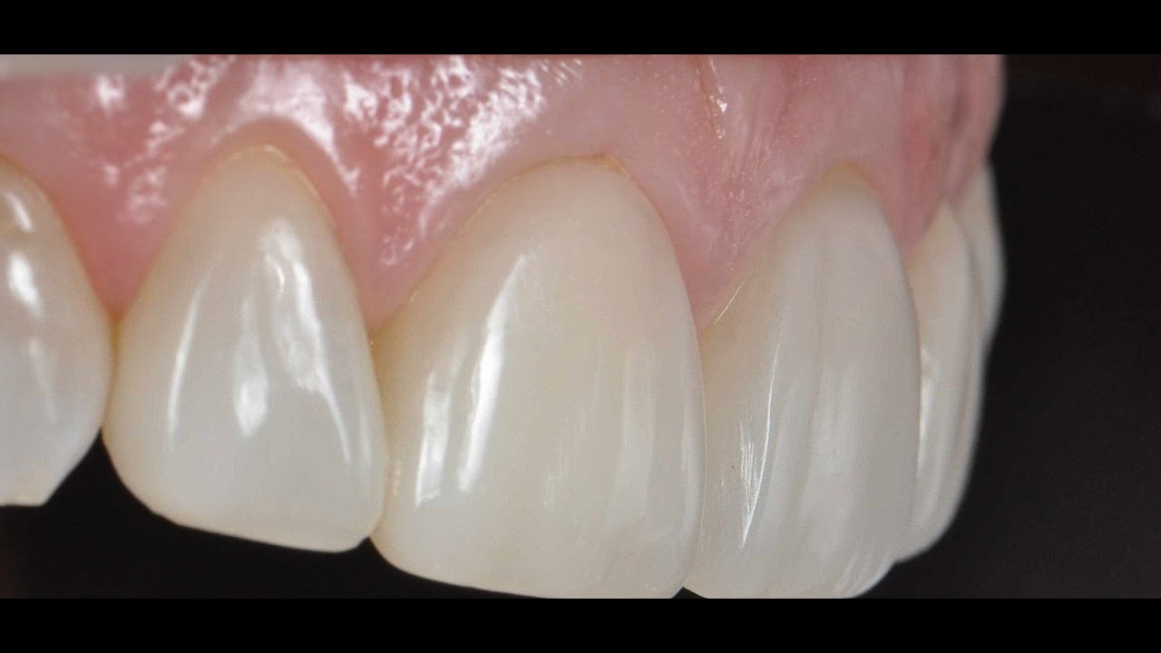 Pressed direct composite veneers
