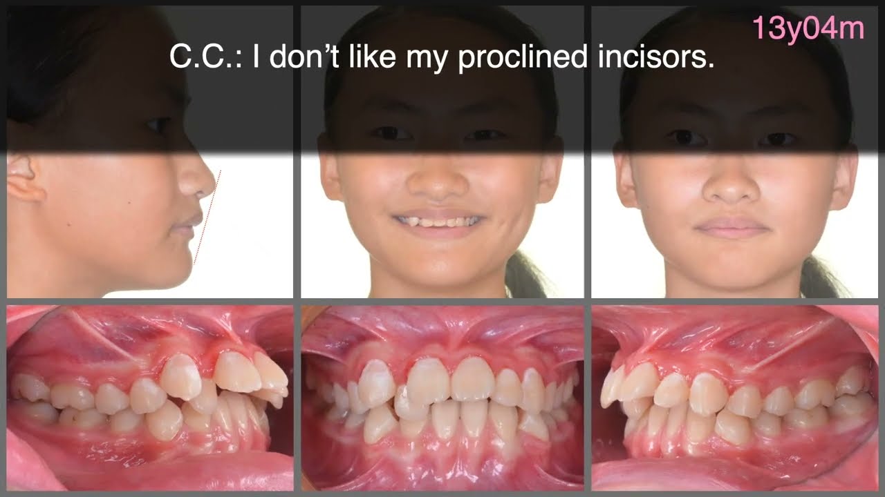 Correction of CML2s & 10mm Overjet by Clear Aligner｜【Chris Chang Ortho】CC625