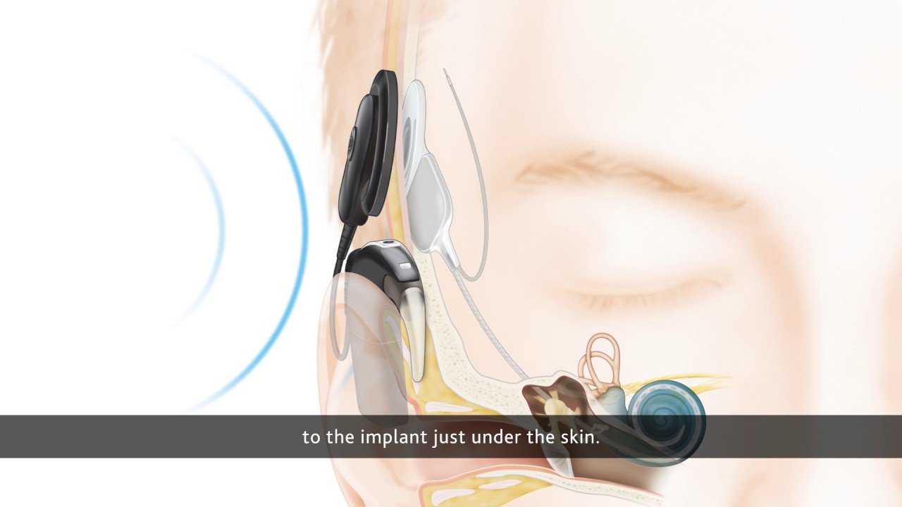 How a Cochlear&trade; Implant works with the Nucleus 6 Sound Processor
